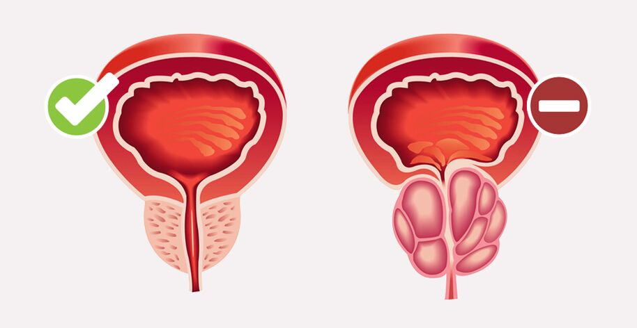 Weiprost normalizes the size and function of the prostate