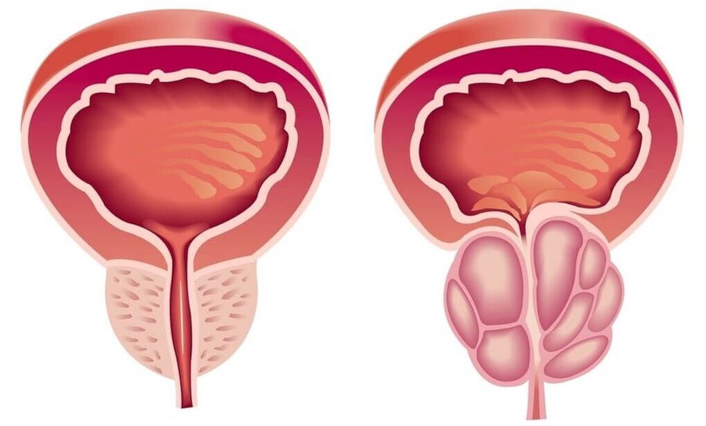 healthy and diseased prostate