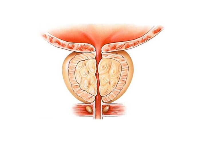 inflammation of the prostate