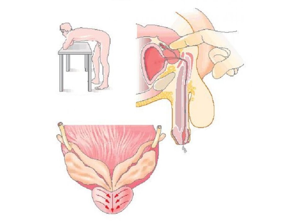 Technique of prostate massage by a doctor to analyze the secretion